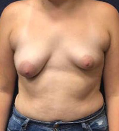 Breast Augmentation with Lift Before & After Gallery - Patient 386908 - Image 1