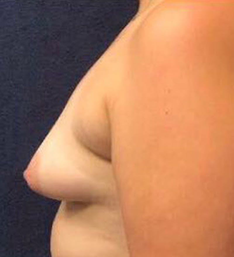 Breast Augmentation with Lift Before & After Gallery - Patient 386908 - Image 3