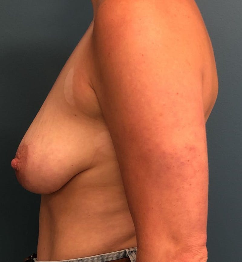 Breast Augmentation with Lift Before & After Gallery - Patient 927215 - Image 3