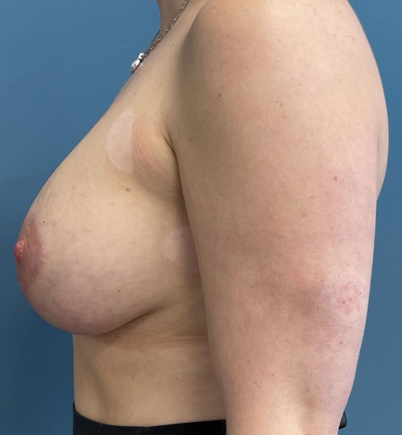 Breast Augmentation with Lift Before & After Gallery - Patient 927215 - Image 4