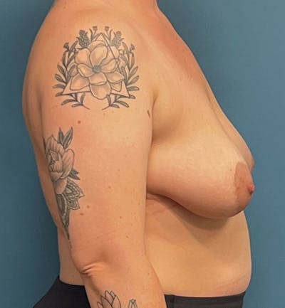 Breast Augmentation with Lift Before & After Gallery - Patient 163865 - Image 1