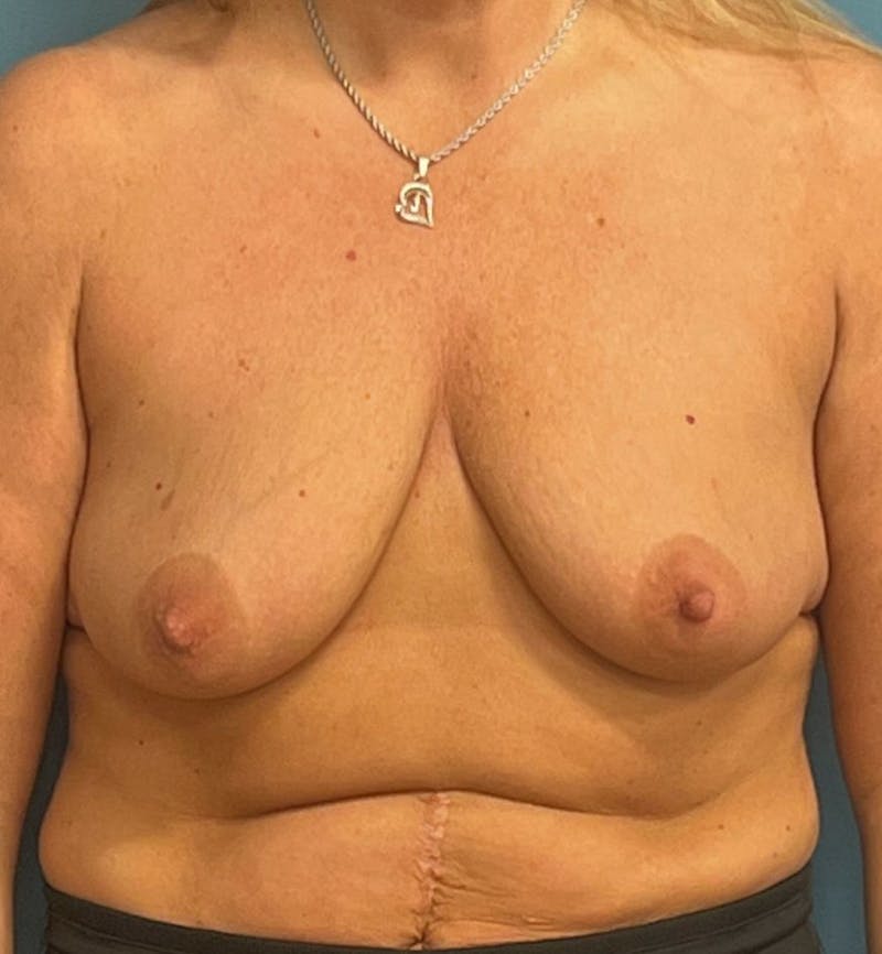 Breast Augmentation with Lift Before & After Gallery - Patient 957160 - Image 1