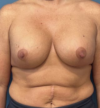 Breast Augmentation with Lift Before & After Gallery - Patient 957160 - Image 2