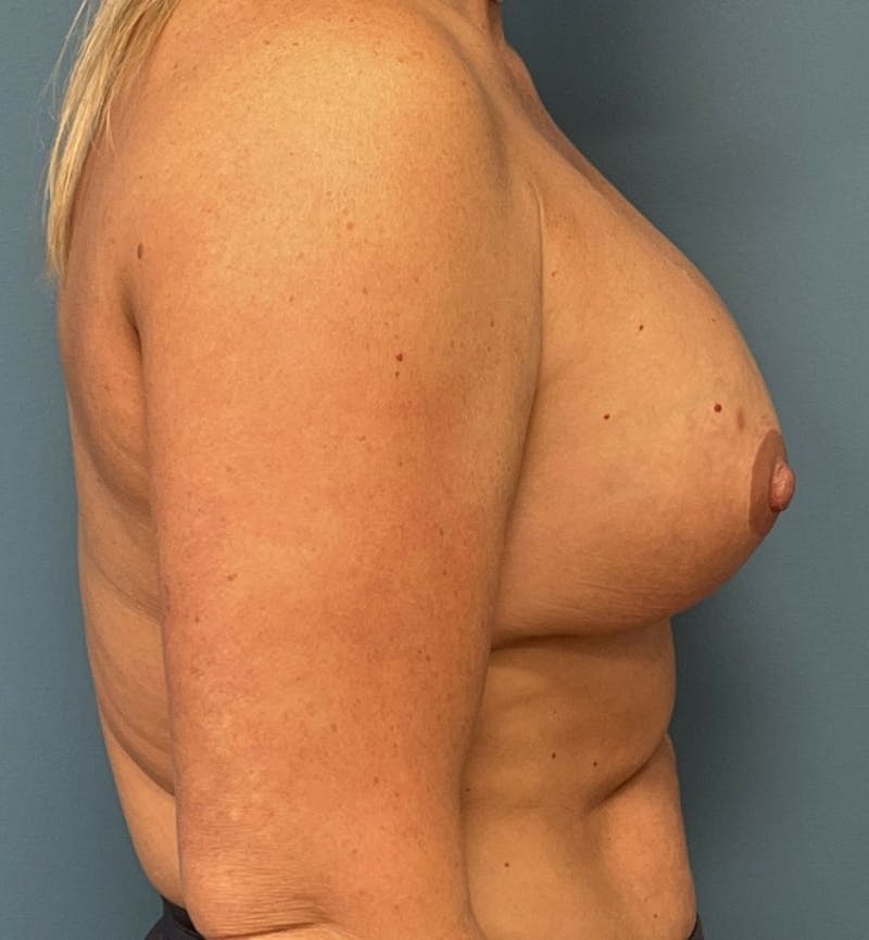 Breast Augmentation with Lift Before & After Gallery - Patient 957160 - Image 4
