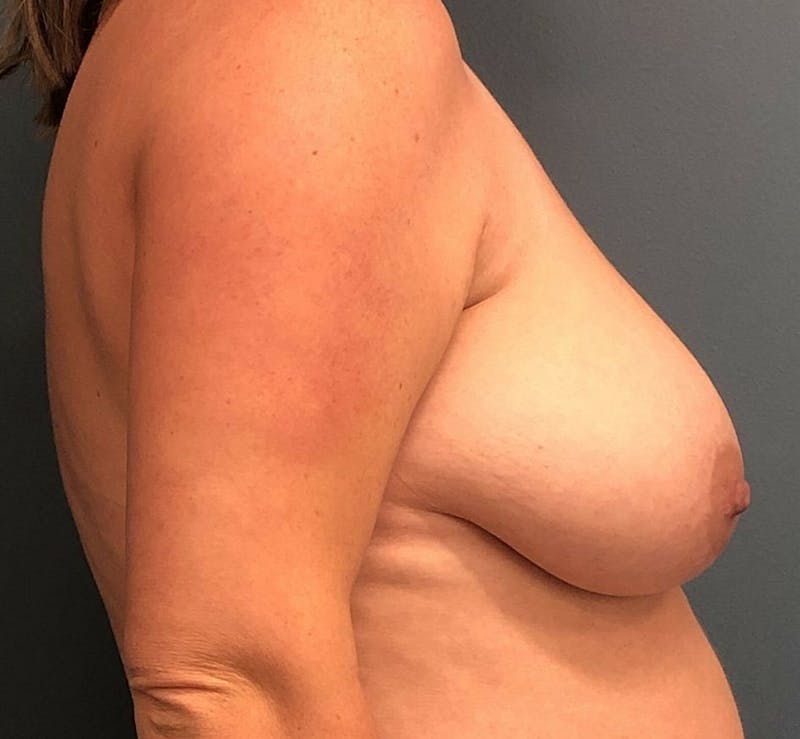 Breast Lift Before & After Gallery - Patient 932433 - Image 3