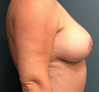 Breast Lift Before & After Gallery - Patient 932433 - Image 4