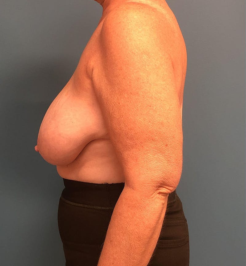 Breast Lift Before & After Gallery - Patient 380169 - Image 3