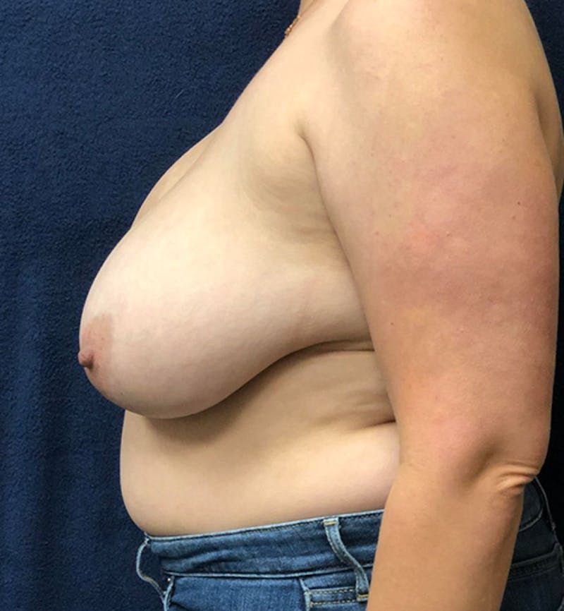 Breast Lift Before & After Gallery - Patient 261220 - Image 3