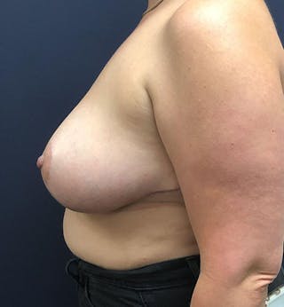 Breast Lift Before & After Gallery - Patient 261220 - Image 4