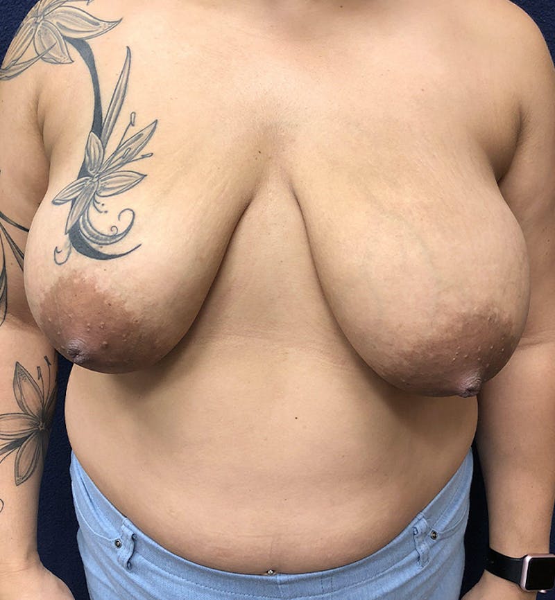 Breast Lift Before & After Gallery - Patient 327508 - Image 1