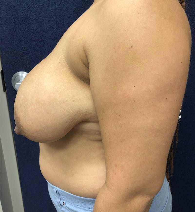 Breast Lift Before & After Gallery - Patient 327508 - Image 3