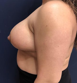 Breast Lift Before & After Gallery - Patient 327508 - Image 4