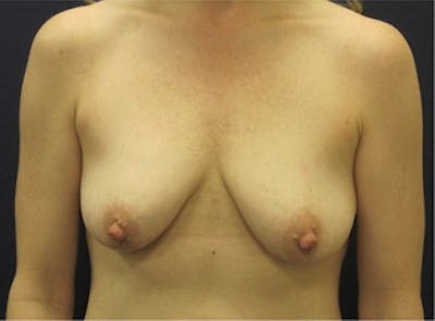 Breast Lift Before & After Gallery - Patient 386150 - Image 1