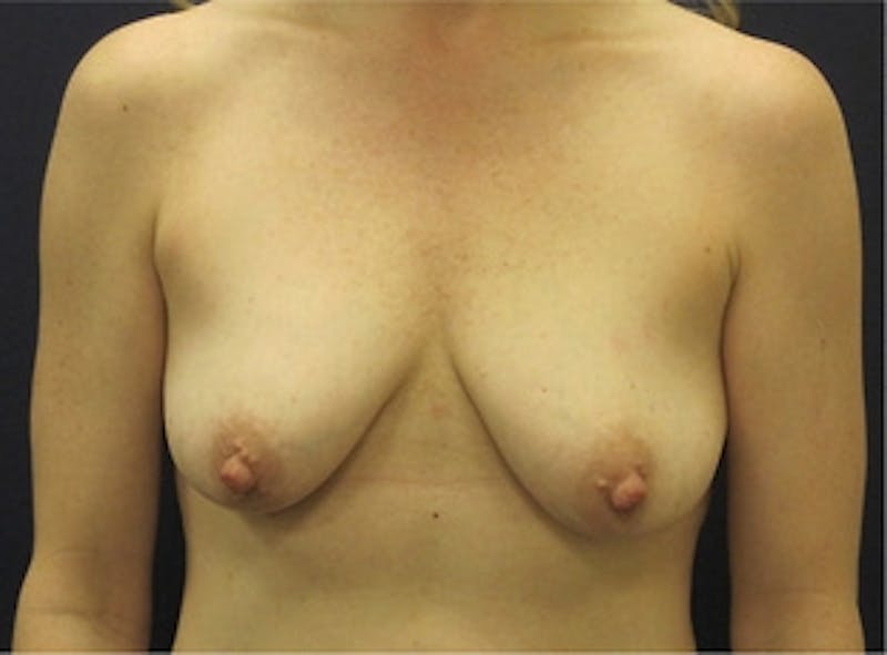 Breast Lift Before & After Gallery - Patient 386150 - Image 1