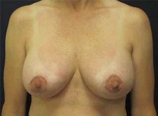 Breast Lift Before & After Gallery - Patient 386150 - Image 2