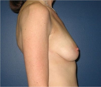 Breast Lift Before & After Gallery - Patient 117258 - Image 1