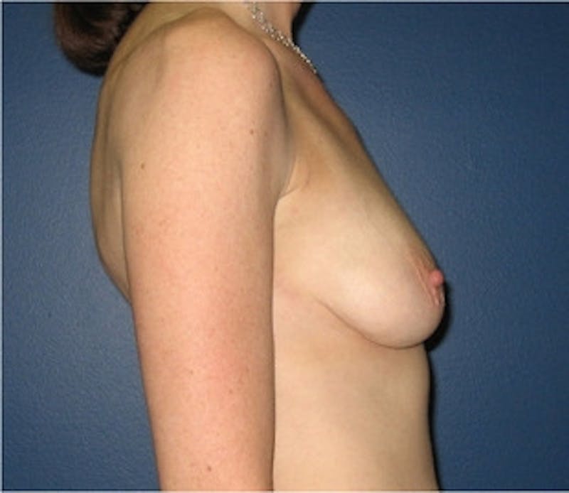 Breast Lift Before & After Gallery - Patient 117258 - Image 1