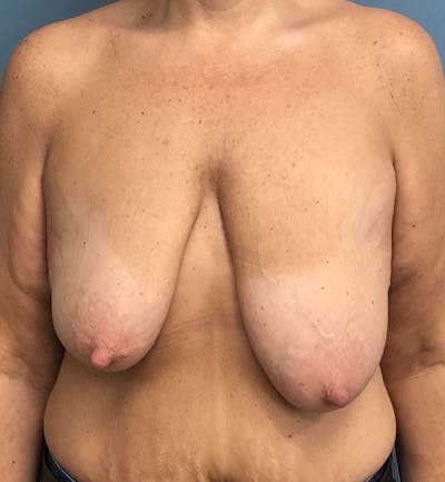 Breast Lift Before & After Gallery - Patient 117437 - Image 1