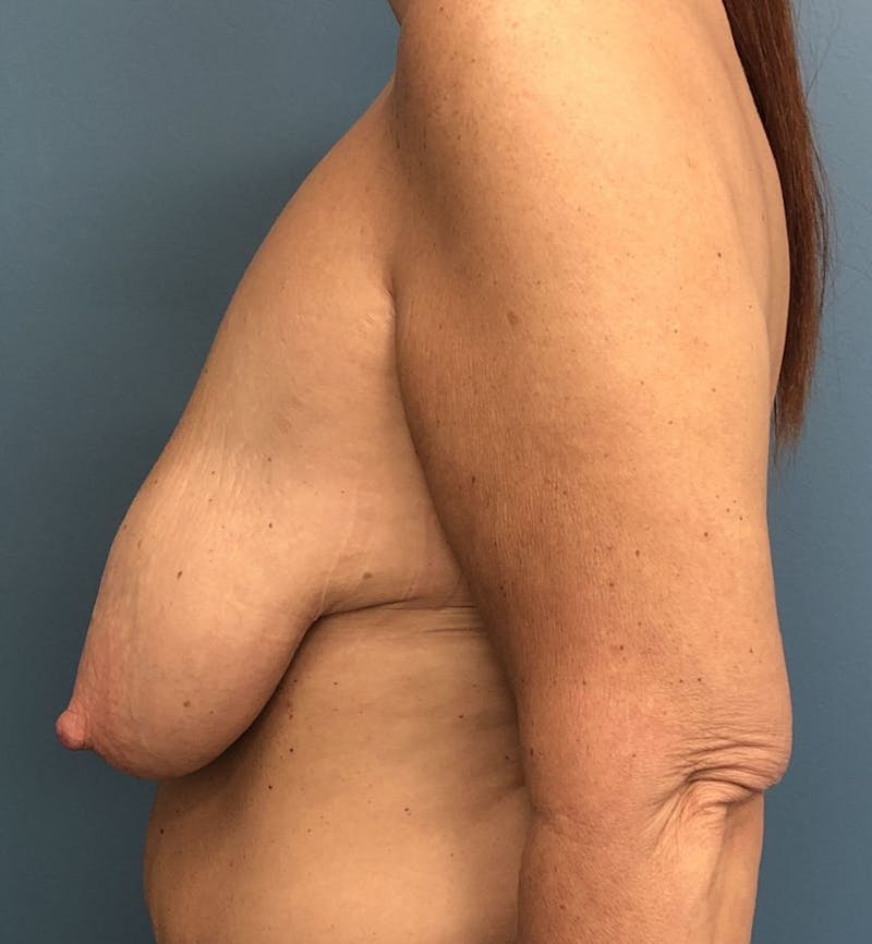 Breast Lift Before & After Gallery - Patient 117437 - Image 3
