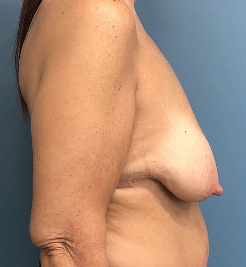 Breast Lift Before & After Gallery - Patient 117437 - Image 5