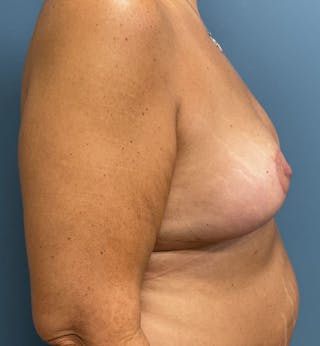 Breast Lift Before & After Gallery - Patient 117437 - Image 6