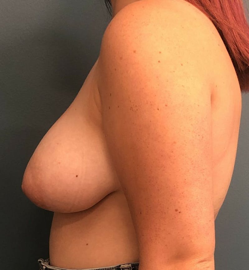 Breast Lift Before & After Gallery - Patient 263486 - Image 3