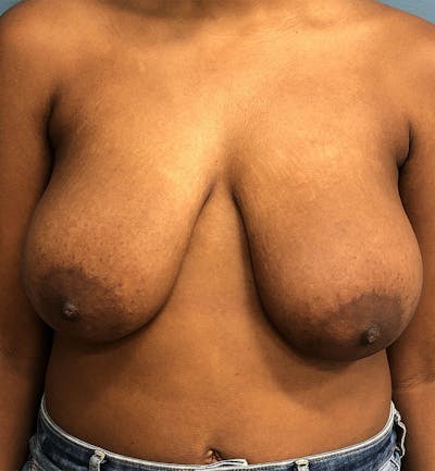 Breast Reduction Before & After Gallery - Patient 343302 - Image 1