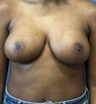 Breast Reduction Before & After Gallery - Patient 343302 - Image 2