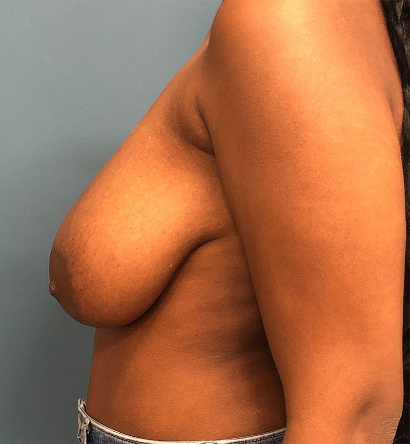 Breast Reduction Before & After Gallery - Patient 343302 - Image 3