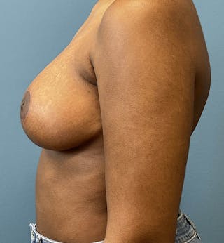 Breast Reduction Before & After Gallery - Patient 343302 - Image 4