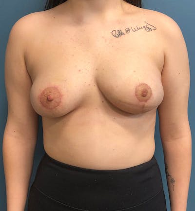 Breast Reduction Before & After Gallery - Patient 323865 - Image 2