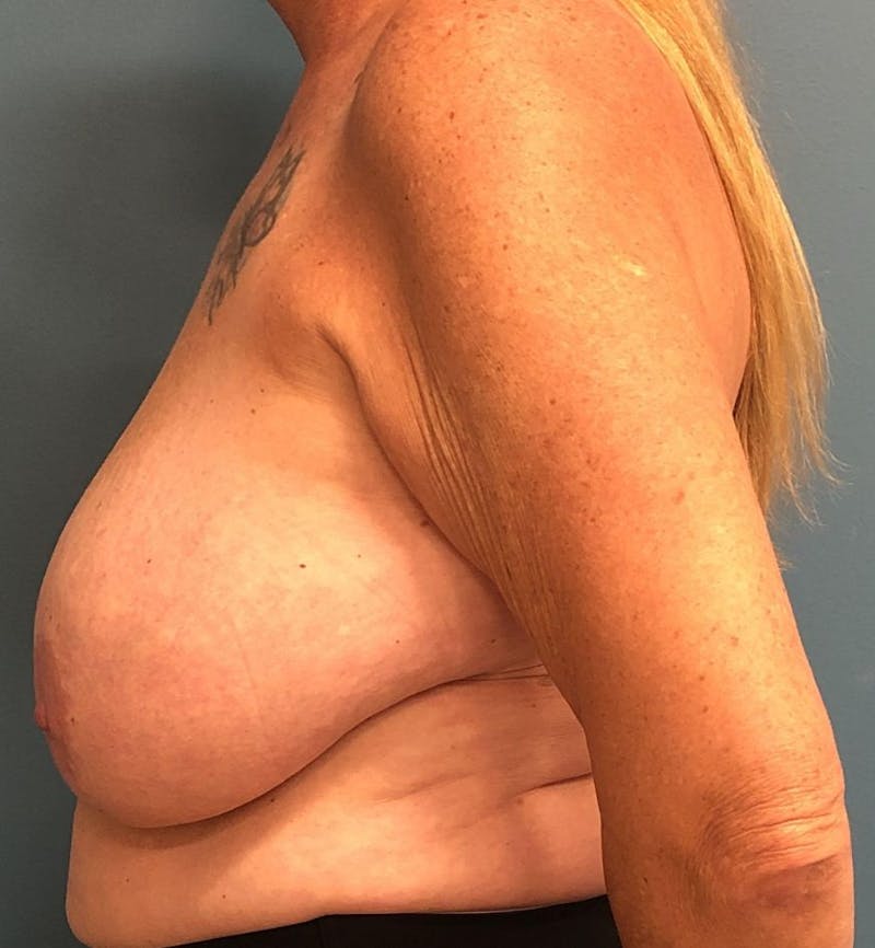 Breast Reduction Before & After Gallery - Patient 220809 - Image 3