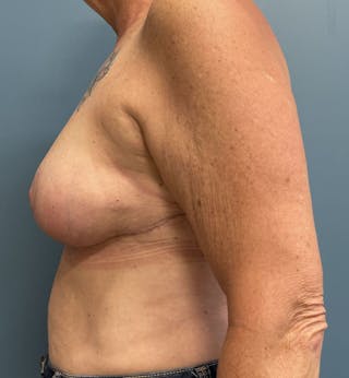 Breast Reduction Before & After Gallery - Patient 220809 - Image 4