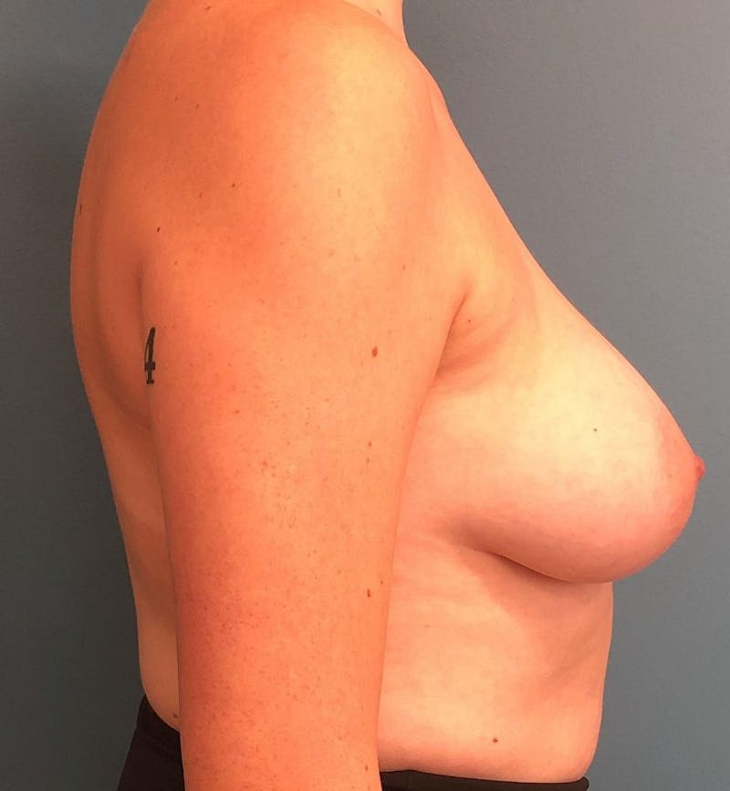 Breast Reduction Before & After Gallery - Patient 346781 - Image 3