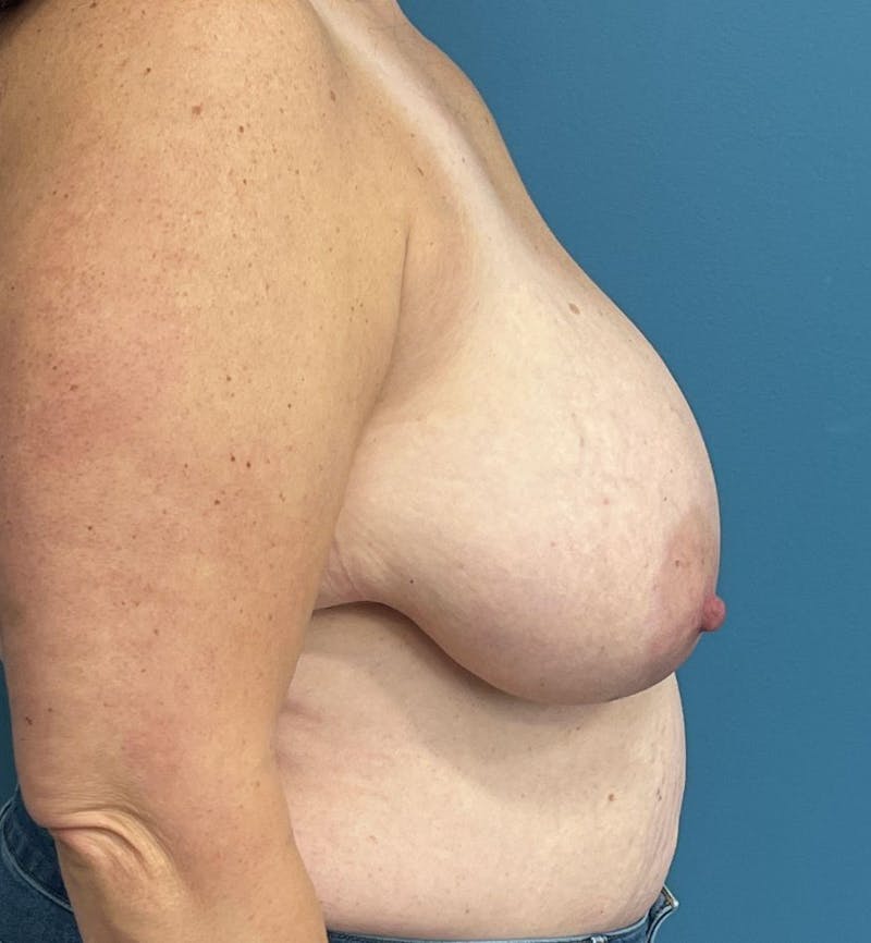 Breast Reduction Before & After Gallery - Patient 143567 - Image 3