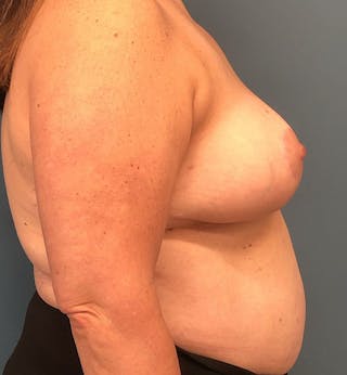 Breast Reduction Before & After Gallery - Patient 143567 - Image 4