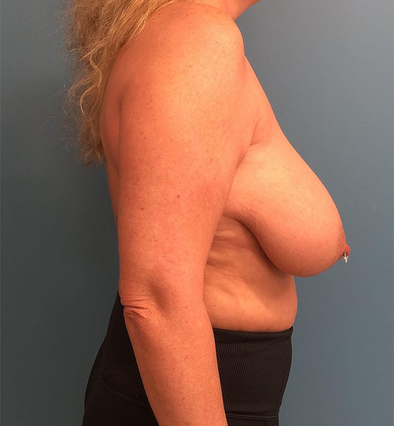 Breast Reduction Before & After Gallery - Patient 346598 - Image 3