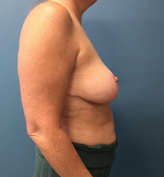 Breast Reduction Before & After Gallery - Patient 346598 - Image 4