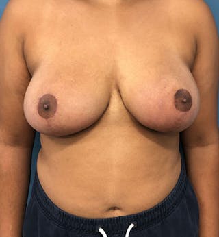 Breast Reduction Before & After Gallery - Patient 297590 - Image 2