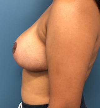 Breast Reduction Before & After Gallery - Patient 297590 - Image 4