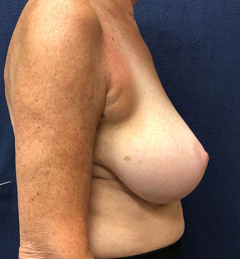 Breast Reduction Before & After Gallery - Patient 124326 - Image 3