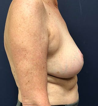Breast Reduction Before & After Gallery - Patient 124326 - Image 4