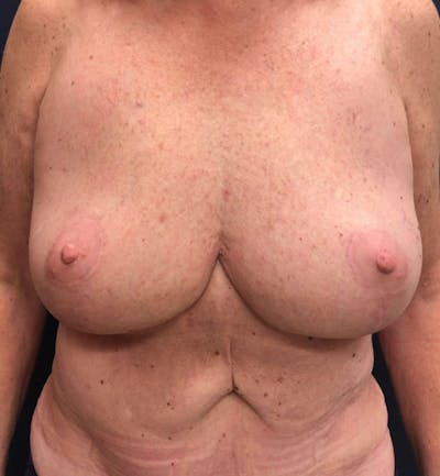 Breast Reduction Before & After Gallery - Patient 401174 - Image 2