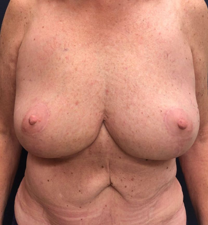 Breast Reduction Before & After Gallery - Patient 401174 - Image 2