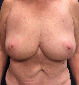Breast Reduction Before & After Gallery - Patient 401174 - Image 2