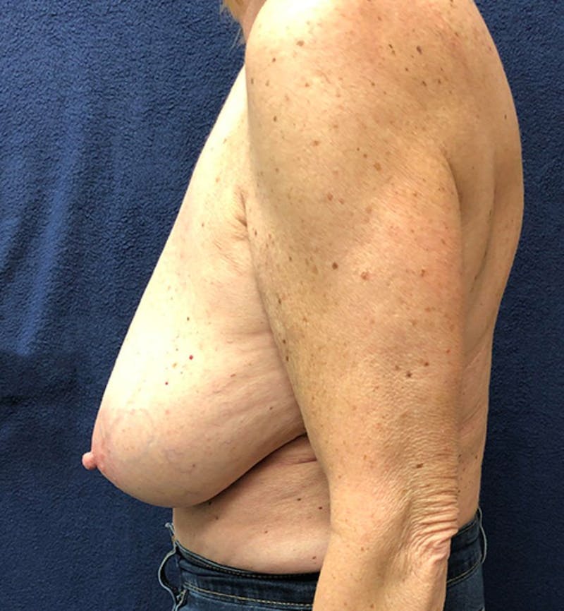 Breast Reduction Before & After Gallery - Patient 401174 - Image 3