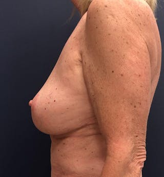 Breast Reduction Before & After Gallery - Patient 401174 - Image 4