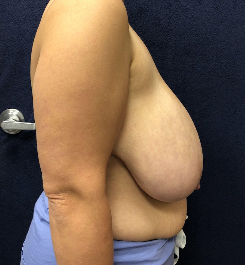 Breast Reduction Before & After Gallery - Patient 291782 - Image 5