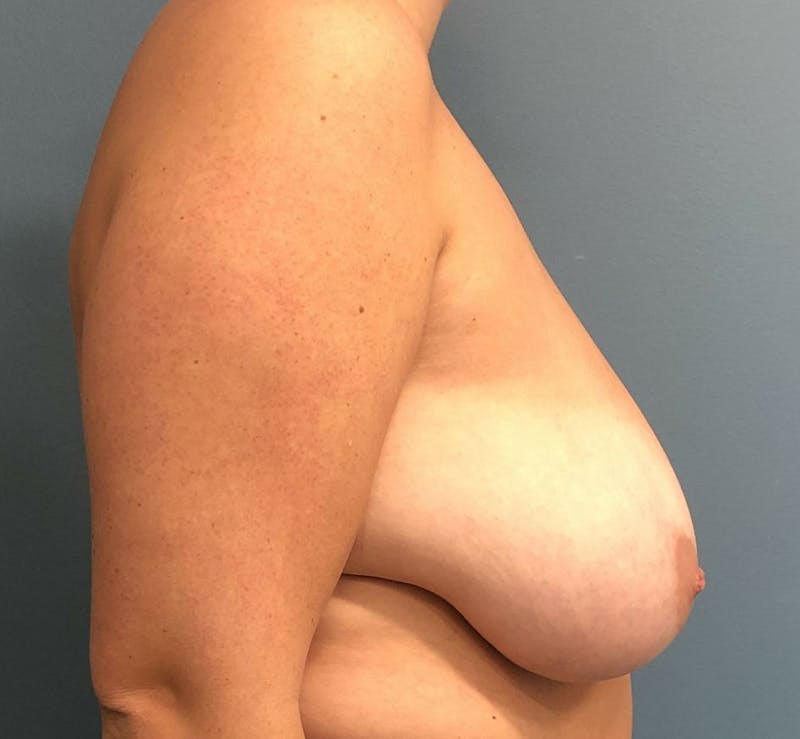 Breast Reduction Before & After Gallery - Patient 238061 - Image 3