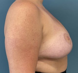 Breast Reduction Before & After Gallery - Patient 238061 - Image 4